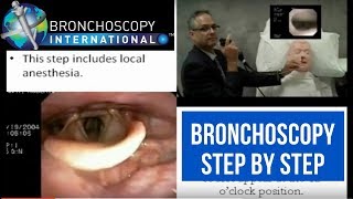 Bronchoscopy Step by Step Walkthrough 16 [upl. by Carree]