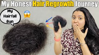 My Hair Loss amp Hair Regrowth Journey  Sharing My Story❤️ [upl. by Refinney]