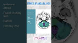 Stroke  basilar artery and AICA PICA [upl. by Lybis]