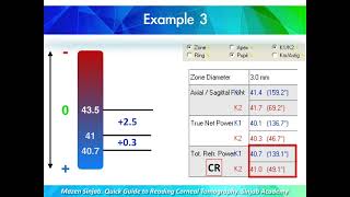 A Quick Guide to Reading Corneal Tomography Part 4 [upl. by Atinomar]