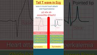 Tall T wave in ecg in heart attack and hyperkalemia lecg shorts [upl. by Eenitsed]