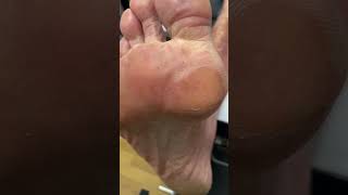 Join our Australian Podiatrist for a smooth journey of forefoot callus removal [upl. by Yrollam]