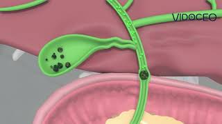 Spanish ERCP Description for Choledocholithiasis [upl. by Amasa593]