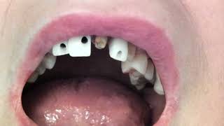 Anterior Temporary Crowns on Implants and Natural Teeth [upl. by Noellyn]