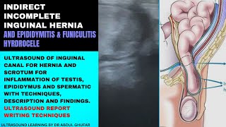 Inguinal hernia ultrasound  hernia signs and symptoms  inguinal hernia report  hernia ultrasound [upl. by Angelina]