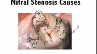 Mitral Stenosis Causes Mnemonic [upl. by Ennirac319]