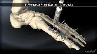 1st Metatarsal Phalangeal Joint Arthrodesis [upl. by Firmin757]