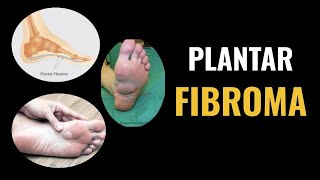 Plantar Fibroma [upl. by Acihsay771]