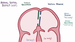 Atrial septal defect ASD repair causes types symptoms amp pathology [upl. by Narrat]