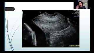 Endovaginal Imaging in MidPregnancy  Lisa Burechailo  Advanced Fetal Imaging Conference [upl. by Nylinej]