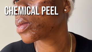 PCA Chemical Peel on Black Skin for Hyperpigmentation and Texture [upl. by Carl66]