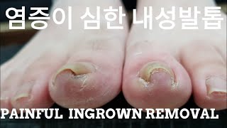 시원함주의😣염증이 심한 내성발톱 교정영상👍PAINFUL INGROWN TOESNAIL [upl. by Ennaylime]