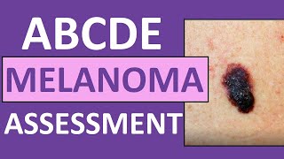 ABCDE Melanoma Skin Cancer Assessment Nursing with Pictures [upl. by Dulcine]