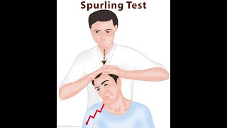 Spurling Test [upl. by Nave]