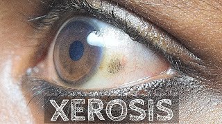 Xerophthalmia  Vitamin A deficiency Part 10 [upl. by Ocsic]