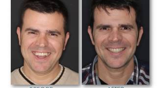 OPEN BITE RESOLVED WITH ORTHOGNATHIC SURGERY  MAXILLOFACIAL  BEFORE AND AFTER [upl. by Allwein]