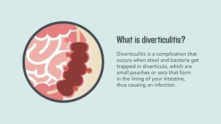 Diverticulitis Signs Symptoms Causes and Treatment  Merck Manual Consumer Version Quick Facts [upl. by Zaria]