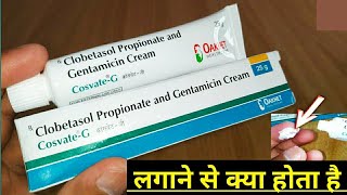 Cosvate G Cream Uses In Hindi  Clobetasol Propionate And Gentamicin Cream  कॉसवेट जी क्रीम [upl. by Cimbura857]