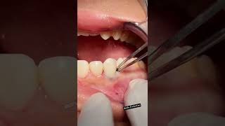 Scaling and Root Planing for Gum Disease MouthHealthy tartar teethscalling dental dentist toot [upl. by Nnalatsyrc]