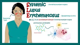 Systemic Lupus Erythematosus  signs and symptoms pathophysiology and diagnosis of Systemic Lupus [upl. by Eimia]