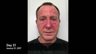 Actinic Keratosis Fluorouracil Treatment 27Day Time Lapse [upl. by Artekal915]