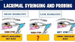 Lacrimal Syringing and Probing  Technique and Interpretation of results [upl. by Ollayos]