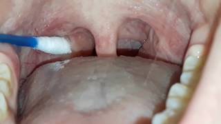 REMOVING TONSIL STONES [upl. by Hosbein896]