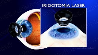 Glaucoma ad angolo chiuso e glaucoma acuto terapia con iridotomia laser wwwoculisticaTVit [upl. by Summer]