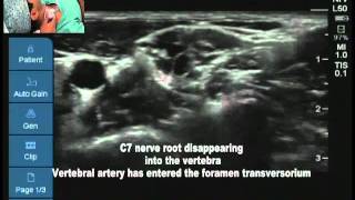 Ultrasound guided interscalene block ultrasound anatomy and vertebral levels [upl. by Anaizit]