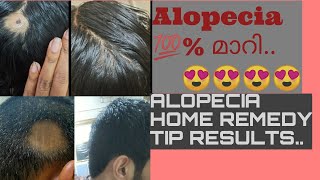 ALOPECIA AREATA HOME TREATMENT RESULTS MALYALAMll വട്ടത്തിൽ മുടി കൊഴിച്ചിൽ ll MIND ME ENTERTAINMENTl [upl. by Thorvald]