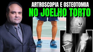 ARTROSCOPIA e OSTEOTOMIA no JOELHO TORTO [upl. by Aivad]