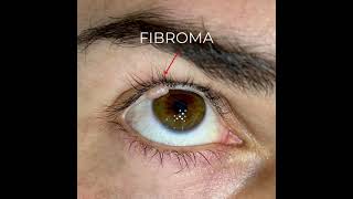 Eyelid Fibroma removal by plasmage ® [upl. by Nahshunn]