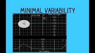 Topic 26 Intrapartum Fetal Surveillance [upl. by Starlene]