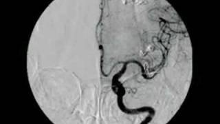 BRAIN ANEURYSM  ANEURISMA CEREBRAL 2 [upl. by Elleinet]