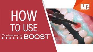 How to Use Opalescence™ Boost™ Professional Teeth Whitening  StepbyStep Procedure [upl. by Mylo]