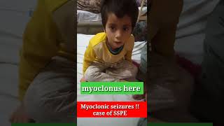 SSPESubacute sclerosing panencephalitis Myoclonus investigation and diagnoisis MeaselsTreatment [upl. by Ahsuatal890]