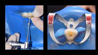 Guided endodontic access for root canal treatment for calcified Maxillary Central Incisor [upl. by Lleda]