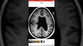 Case 036 Closed lip Schizencephaly and absent septum pellucidum [upl. by Ardaid]