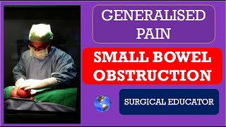 SMALL BOWEL OBSTRUCTION How To DIAGNOSE amp TREAT  GENERALISED ABDOMINAL PAIN [upl. by Sackey]