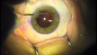 Cataract Eye Surgery Acrysof IQ ReSTOR Multifocal Toric Хирург Бойко АА [upl. by Nnaylime]