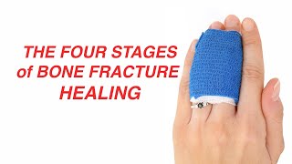 The Four Stages of Bone Fracture Healing [upl. by Suoilenroc]