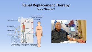 Acute Kidney Injury Part 33  Treatment and Complications [upl. by Leonore577]