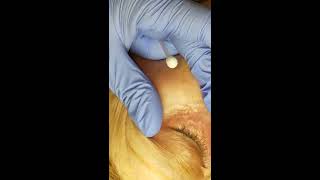 Skin classic treatment of Syringoma [upl. by Soneson]