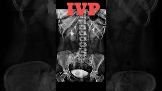 IVP  Intravenous pyelography shorts ivp specialcase radiology radiologyjunction [upl. by Bradley]