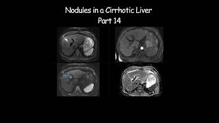 Nodules in a Cirrhotic Liver  Part 14 radiology radiologist cirrhosis liverdisease liverhealth [upl. by Lizzy]