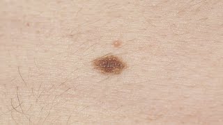 Melanoma symptoms How to spot signs and when to see a doctor [upl. by Scholem]