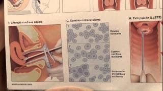 Qué es el papanicolau [upl. by Mcloughlin]