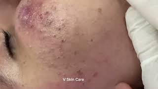 Remove ACNE FAST With These Treatment Secrets63 [upl. by Eliseo839]