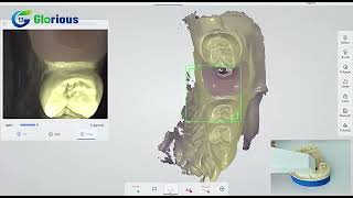 Panda2 intraoral scanner scanning mandibular implant [upl. by Sarilda]