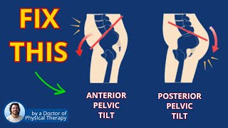 Anterior Pelvic Tilt Fix for Back Pain Relief  Exercise [upl. by Enyaj]